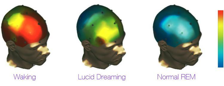 Lucid Dreams Under fMRI