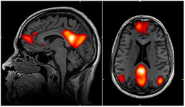 default network brain scan